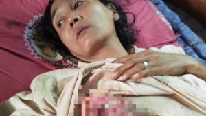 Siti Penderita Kanker Payudara di Tebo, Butuh Uluran Tangan Dermawan