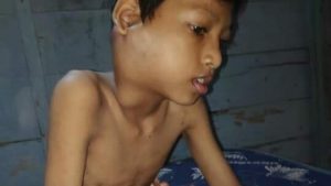 Eka Dani Saputra Penderita Tumor Ganas, Butuh Bantuan Pemda Merangin