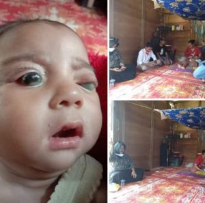 Bayi di Merangin Butuh Uluran Tangan, Mata Keluarkan Nanah