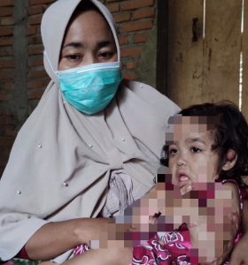 Tersiram Air Panas, Begini Kondisi Listiya dan Butuh Uluran Tangan Dermawan