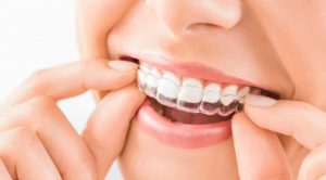 Apakah Bisa Lepas Behel Tanpa pakai Retainer Gigi?