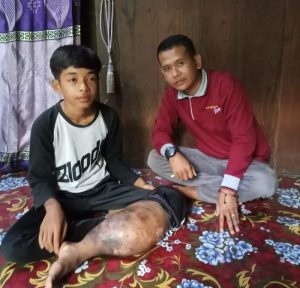 Alpian Putra, Penderita Tumor Ganas Butuh Uluran Tangan Dermawan