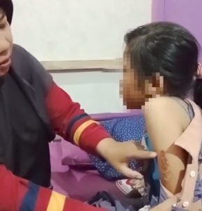 Diduga Seorang Ibu di Bungo Aniaya Anak Tiri dengan Cara Disetrika 